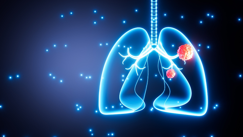 La pollution de l’air stimule les mutations du cancer du poumon chez les non-fumeurs La_pollution_de_l_air_stimule_les_mutations_du_cancer_du_poumon_chez_les_non_fumeurs