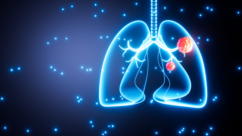 1 sur 5 cas de cancer du poumon touche des non-fumeurs—voici pourquoi 1 sur 5 cas de cancer du poumon touche des non-fumeurs—voici pourquoi